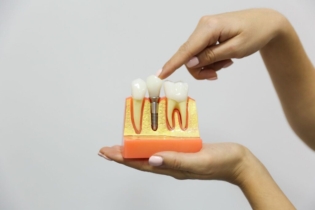 cost of dental implants