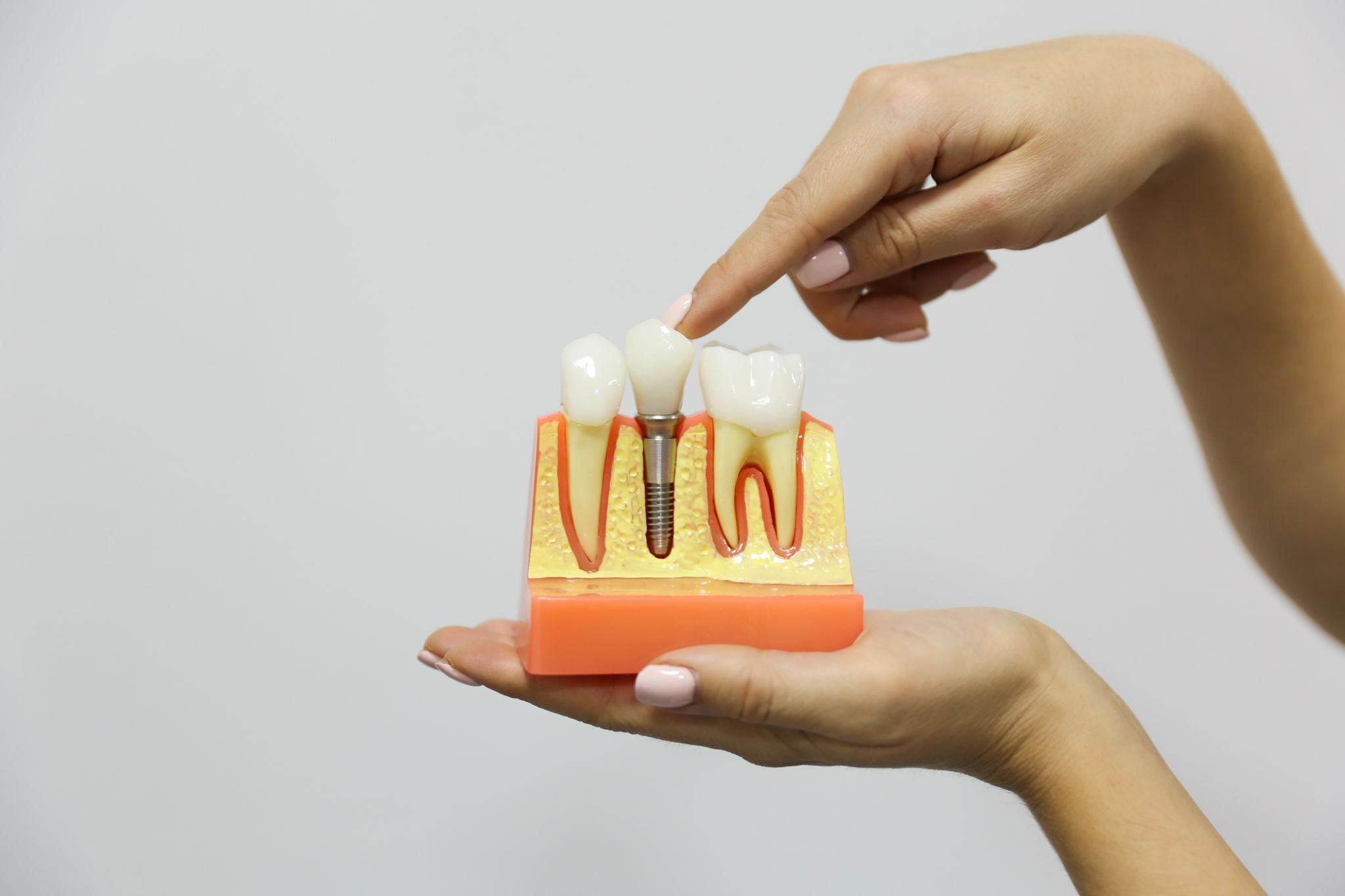 cost of dental implants