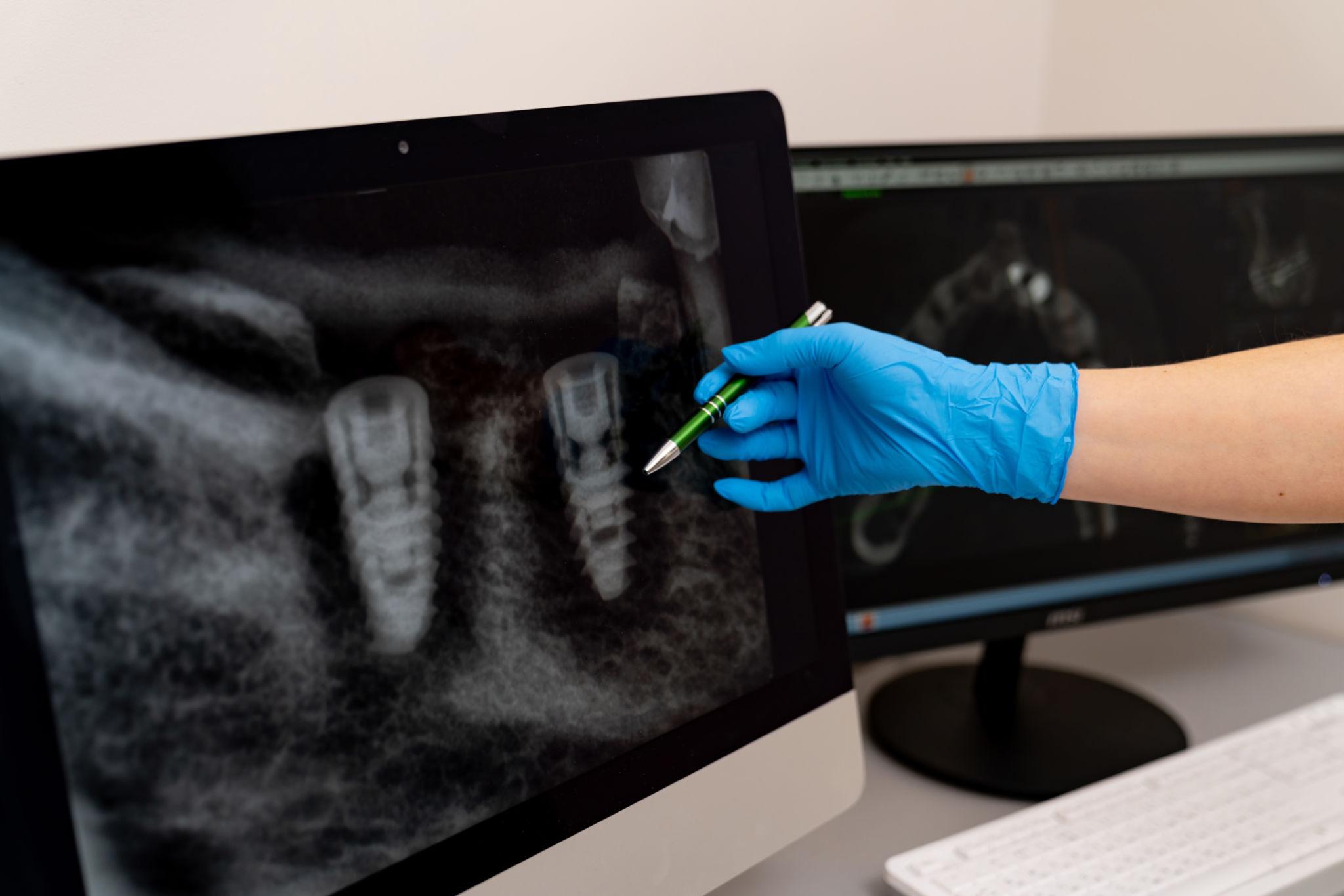 How Long Do Dental Implants Last