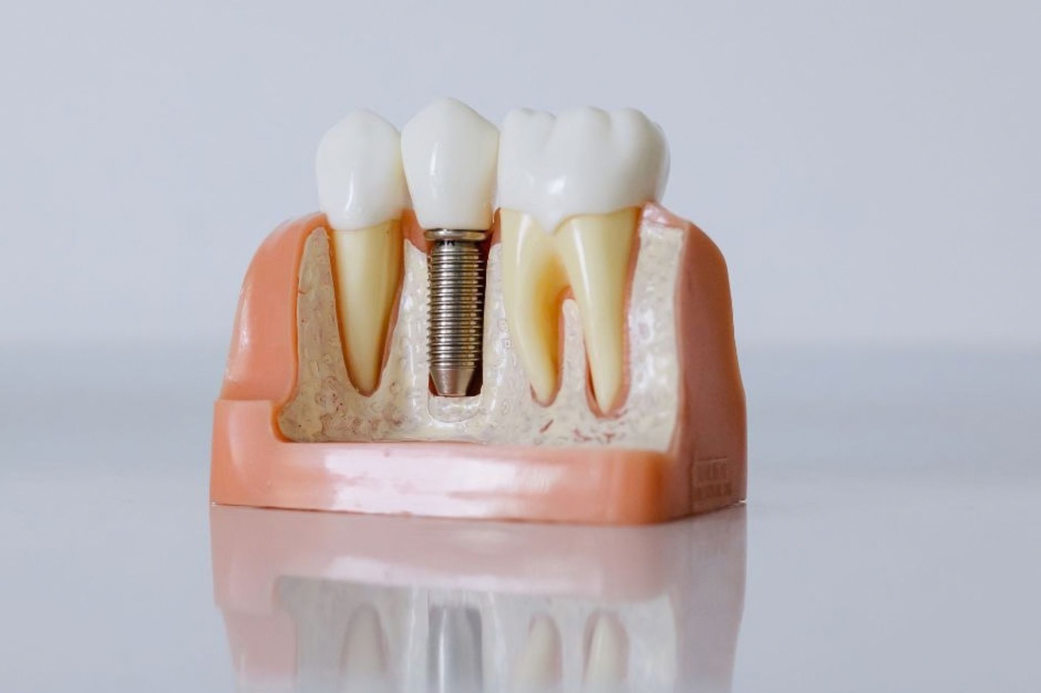 All-on-4 Dental Implants